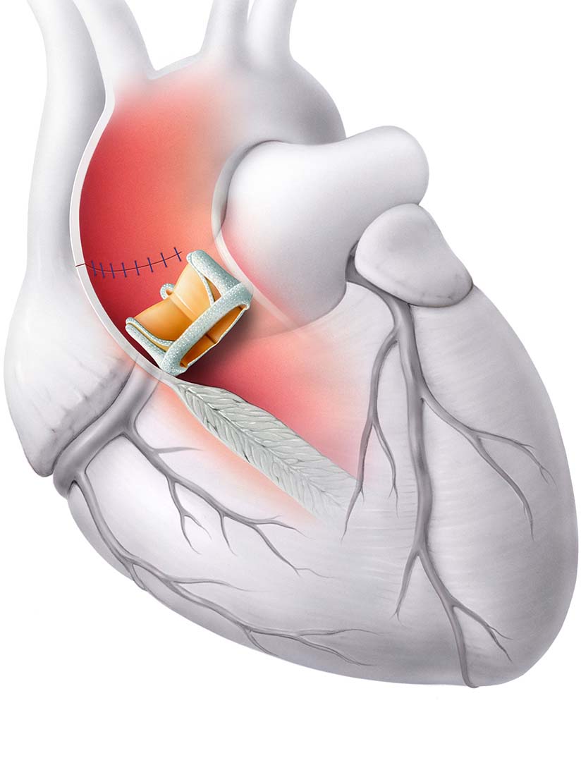 Herz: Chirurgischer Aortenklappenersatz